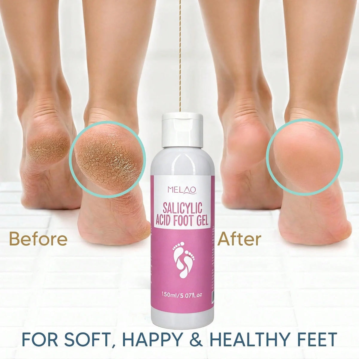 MELAO Salicylic Acid Foot Gel - Dead Skin & Callus Remover, Exfoliating Treatment for Rough Cracked Feet, Softens Heels, 150ml