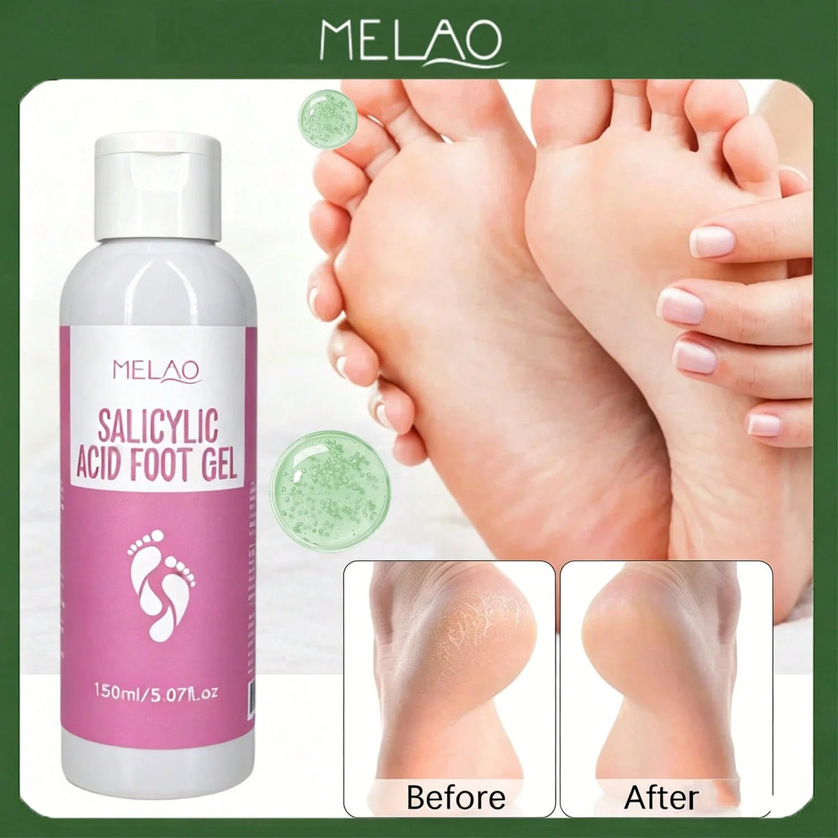 MELAO Salicylic Acid Foot Gel - Dead Skin & Callus Remover, Exfoliating Treatment for Rough Cracked Feet, Softens Heels, 150ml
