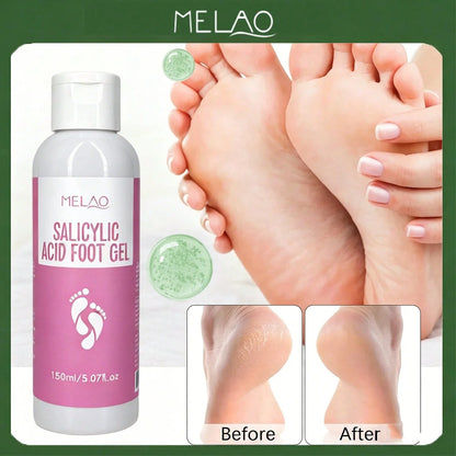 MELAO Salicylic Acid Foot Gel - Dead Skin & Callus Remover, Exfoliating Treatment for Rough Cracked Feet, Softens Heels, 150ml