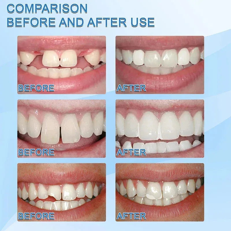 5-100g Moldable False Teeth Tooth Repair Granules Tooth Beads Temporary Filling For Rooth Broken Tooth Repair Kit Thermal Fit